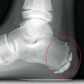 Heel pain (Sever's disease)