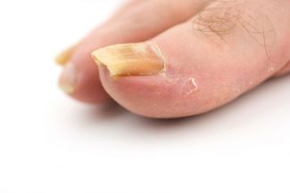 Onychomycosis